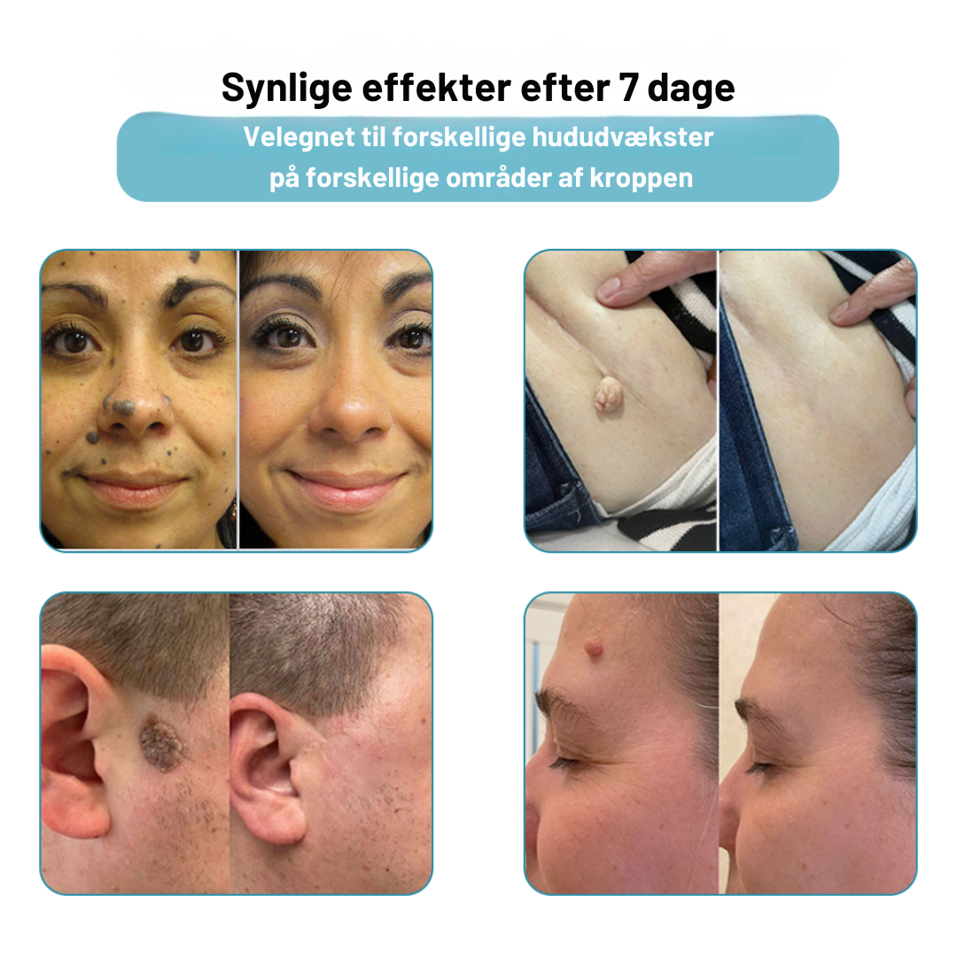 FläckBort | Fjerner effektivt hudproblemer!