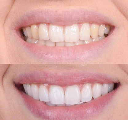 PerleHvid | Tandblekningspenna – Kliniskt inspirerad blekning hemma