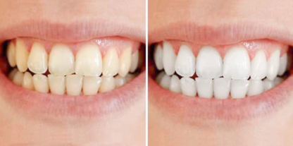 PerleHvid | Tandblekningspenna – Kliniskt inspirerad blekning hemma