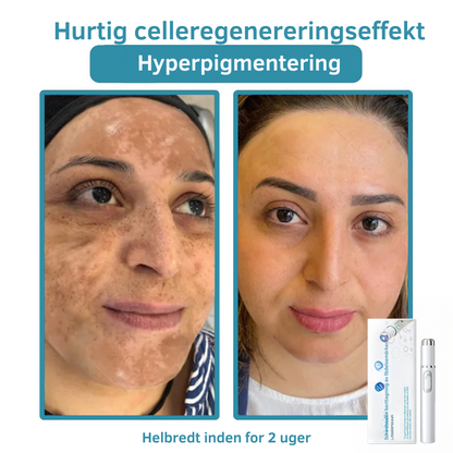 FläckBort | Fjerner effektivt hudproblemer!